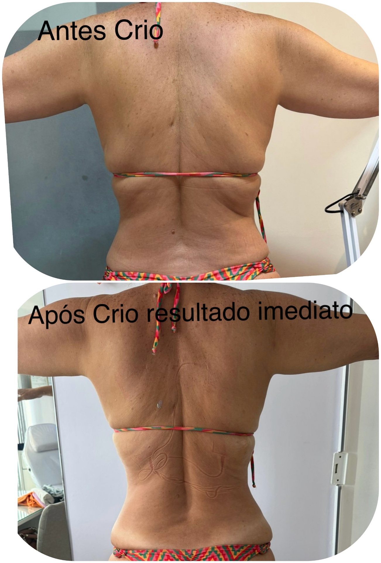 Antes e depois de criolipólise nas costas