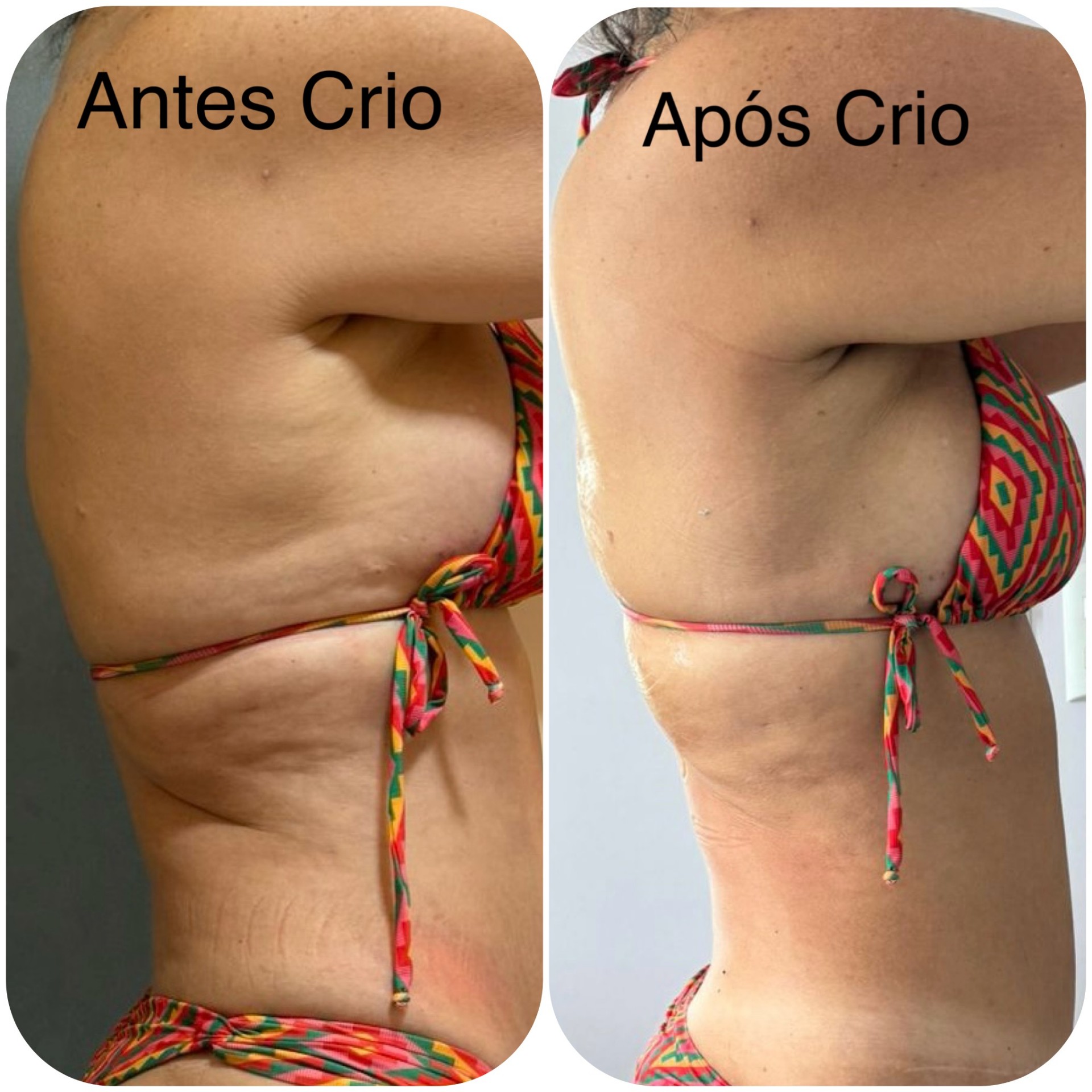 Antes e depois de criolipólise nos flancos